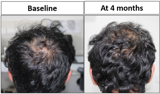 Pt. 2 had significant increased hair density at vertex region at 4 months from baseline.