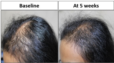 Pt 4 showed significant improved terminal hair growth in temporal and saggital areas at 5weeks.