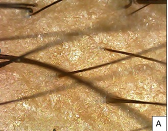 Pt 8 At baseline, multiple primary rooted telogen hairss seen at vertex.